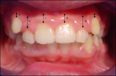 Figure 2 Figure (1): Average of keratinized gingiva width akgw is expressed as the sum of KGW records on all the teeth in every group and divided by 6 significant changes were observed in the scores