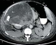 Adrenocortical carcinoma Collision tumor CT + CT + 2 Histologically different tumors in adrenal gland Rare benign/benign; benign/malignant;