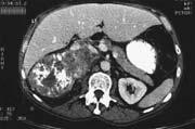 . Metastasis in an adenoma is the main entity of concern CT and PET; biopsy Conn syndrome Conn syndrome Primary Hyperaldosteronism (most common cause of
