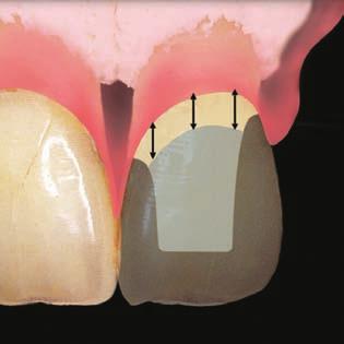 Figure 1 The concept of ferrule, the amount of tooth between the margin of the build-up and the margin of the restoration.