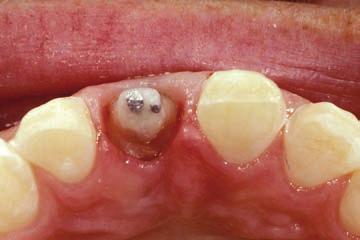 As a general rule, whether using surgery or forced eruption and surgery, it will be necessary to have at least 4 mm of tooth exposed above the bone on both the buccal and lingual surfaces.