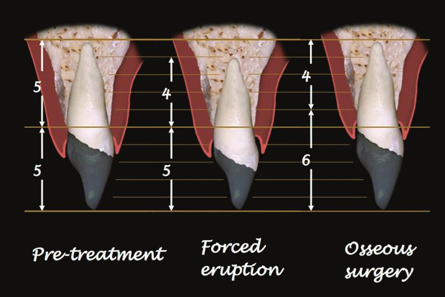 For a maxillary anterior tooth, if the author can retain 8 mm to 9 mm of root in the bone he will generally consider retaining the tooth.