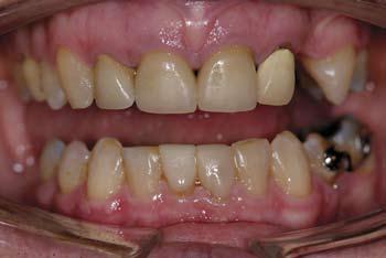 The treatment plan included sealing and root planning, along with orthodontic therapy to manage the spaces and to align the teeth in proper centric relation