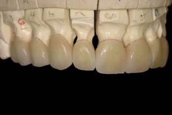 DENTAL LAB PROCEDURES LSK full colored treatment plan wax-ups with frame support were completed on the maxillary (Fig 6).