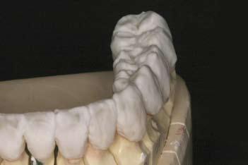 The Kavo Everest Zirconia single copings were completed for 22 through 29 and a 3 unit Zirconia bridge for 18 20.