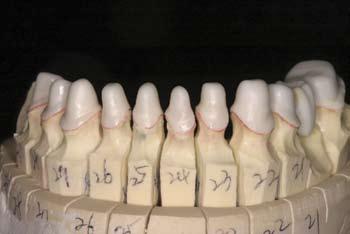The porcelain build up was built to full contour and included tooth morphology and anatomy.