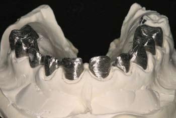 Occlusion is checked of the Kavo Everest restorations on the mandible. Fig 14.