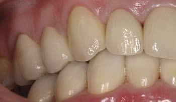 The restorations were tried in and evaluated for color, contour, texture, bite and proper esthetic harmony to the patients face