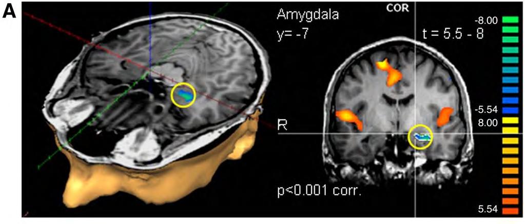 Decreasing amygdala activation regulates emotional & social networks Thinking specifically about your own emotions causes a decrease in activation of the amygdala compared to general selfreflection