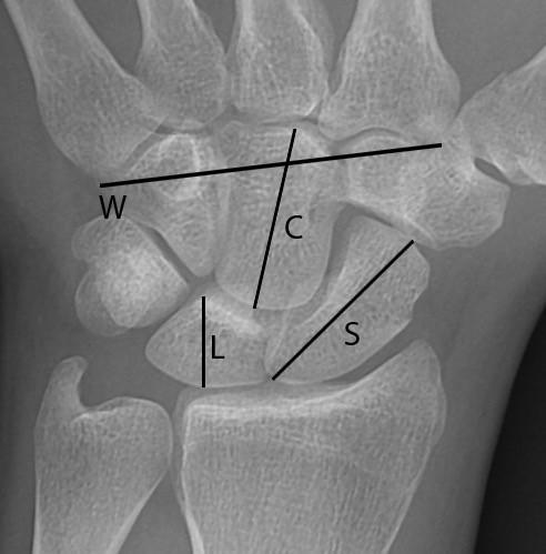 Lunate width is the maximum diameter of the lunate prolonged to radius alignment in wrist AP radiographs [Figure 8L].