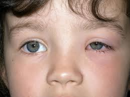 S/S: Preseptal cellulitis Edematous,erythematous eyelids Extraocular
