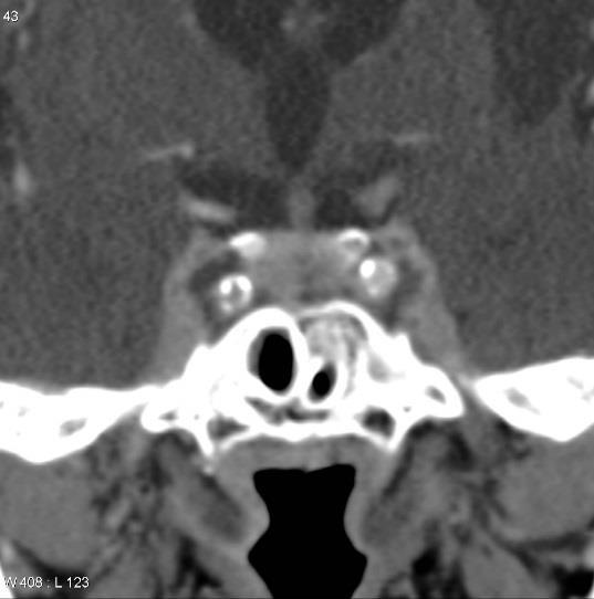Cavernous sinus thrombosis S/S: Bilateral orbital pain,