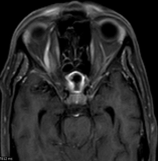 can be affected Dx: MRI with contrast Rx: Medical therapy Sinus