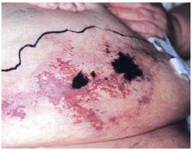 Calciphylaxis calcific uremic arteriolopathy a syndrome of vascular calcification, thrombosis, and skin necrosis seen in patients with (ESRD) and results in chronic