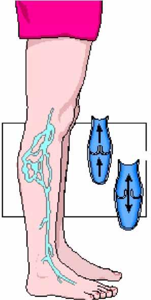 Patient information and consent Day Case - Varicose Veins Surgery Ref: INFOrm4U DC09 What are varicose veins? Varicose veins are enlarged and twisted veins in the leg.