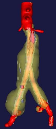 Case Overview 5.4cm AAA with 5mm Length Neck and Bilateral CIAA >2.
