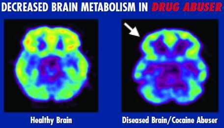 Brain imaging studies from drug-addicted individuals show physical changes in areas of the