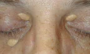Xanthomas The most common dermatologic manifestation