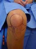 Knee Inferolateral or medial Best for