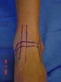 Ankle HAND Hallucis Artery Nerve Digitorum Stay