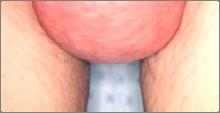 hernia are to reduce it and maintain its