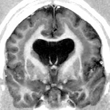 Epileptogenesis: Aetiology trauma stroke others CVD Idiopathic Hauser et al