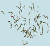 Chromosomal syndromes (Trisomy 21, Ring 20 etc ) Storage diseases (Tay-Sachs, Lafora etc )