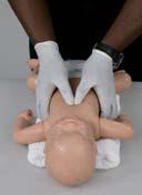 Skill 31-3: Infant Chest Compressions 2-Thumbs Encircling Hands Technique 1. Position yourself at infant s feet or side 2.
