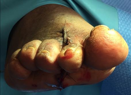 Literature Revision of failed foot surgery: a critical analysis n = 244 Most common reason for revision Transfer metatarsalgia Recurrent bunion