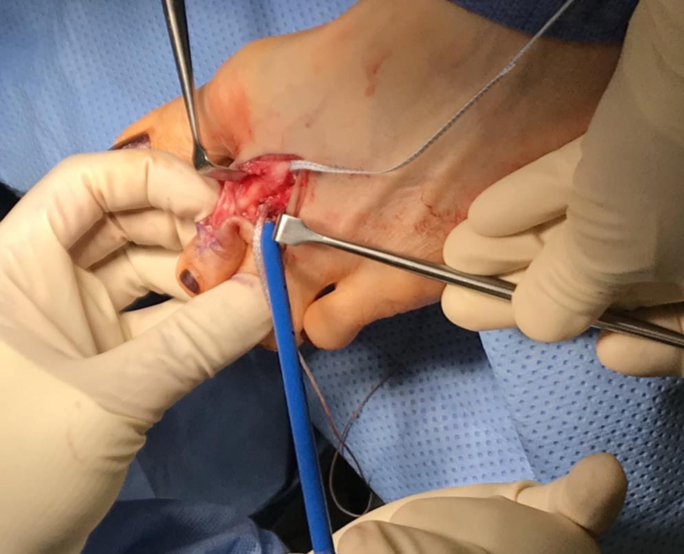 Case Scenario- EDB Transfer Surgical approach Metatarsal bone tunnel Pass suture under deep intermetatarsal ligament Proximal phalanx bone tunnel Adjust tension