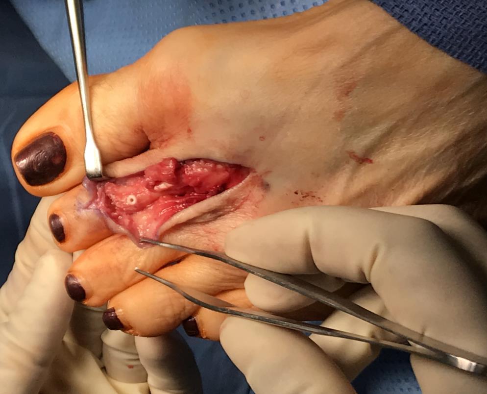 Case Scenario- EDB Transfer Surgical approach Metatarsal bone tunnel Pass suture under deep intermetatarsal ligament Proximal phalanx bone tunnel Adjust tension