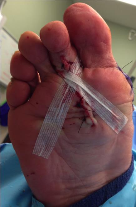 Bandaging Taping Splinting