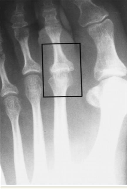 Staging MPJ Instability Stage 1 Subtle edema with pain to plantar MPJ Most (70-90%) alleviate in several days Stage 2 Moderate edema Radiographic deviation of digit Loss of toe purchase Poor response