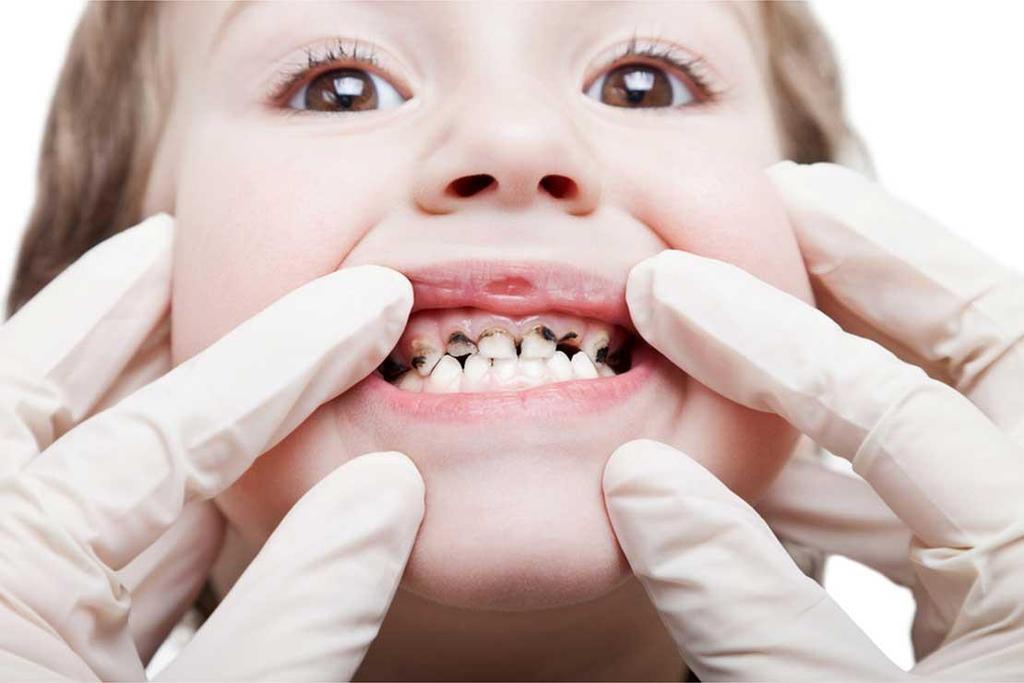 Economic and individual costs of childhood tooth decay and the role of Fluoride Varnish in prevention 1.6 million US school absences were attributed to dental conditions.
