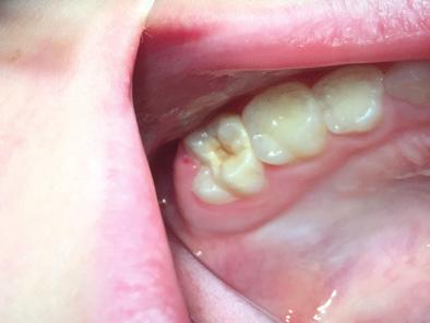 Evidence-Based Clinical Practice Guideline on Nonrestorative Treatments for Carious Lesions: A Report from the American Dental Association Summary of clinical recommendations for the nonrestorative