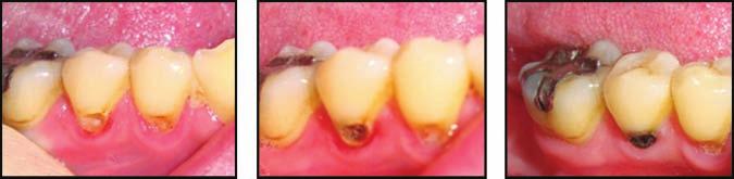 J Dent Res 90(2) 2011 Diammine Silver Fluoride for Sensitive Teeth 207 Table 3.