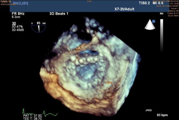 15 Tiara Market Opportunity Success of transcatheter aortic valves has positioned transcatheter mitral valve replacement as a major area of industry/clinical interest 600,000 new