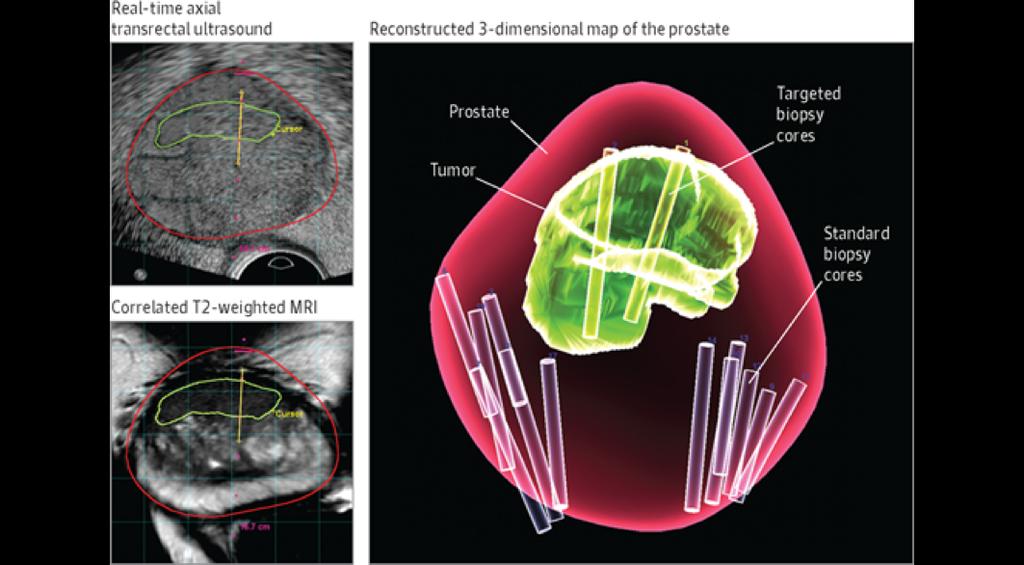 TRUS MRI fusion biopsy TRUS MRI fusion biopsy Evidence for Prostate MRI Evidence for Prostate MRI Prospective study 223 biopsy