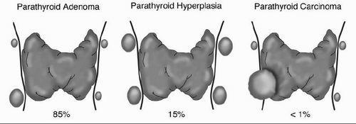 Primary Hyperparathyroidism one or more of your parathyroid glands become enlarged and overactive.