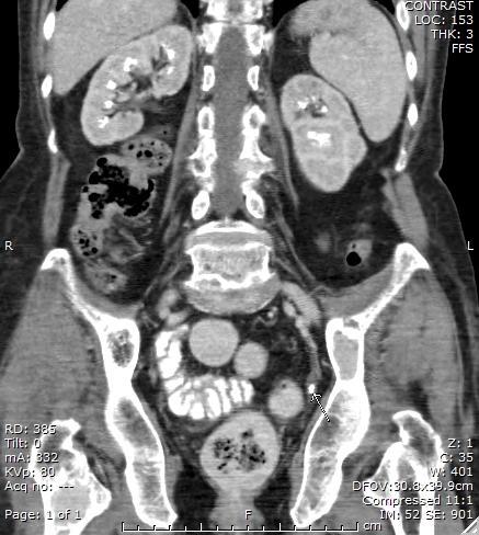 Primary Hyperparathyroidism Clinical present - renal kidney