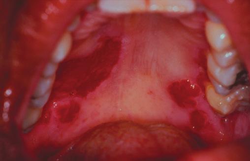 70 Diagnosis and Management of Oral and Salivary Gland Diseases A B FIGURE 4-28 A, Shallow irregular erosions on the buccal mucosa and ventral surface of the tongue caused by pemphigus.