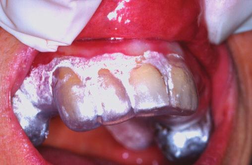76 Diagnosis and Management of Oral and Salivary Gland Diseases FIGURE 4-39 Soft medication splint used to treat desquamative gingivitis secondary to erosive lichen planus. ulcers.