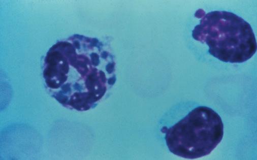 54 Diagnosis and Management of Oral and Salivary Gland Diseases FIGURE 4-5 Cytology smear stained with Giemsa, demonstrating multinucleated giant cells.