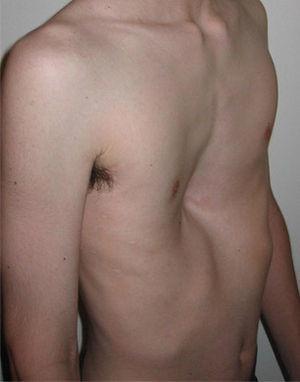 - Case (5): pectus excavatum is a chest deformity caused by increased