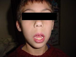 surgically repaired cleft lip which can be isolated or associated with