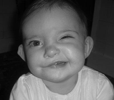 Cleft lip can be associated with cleft palate.