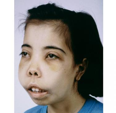 - Case (15): chipmunks facies is seen in patient with β-thalassemia major in which there is total