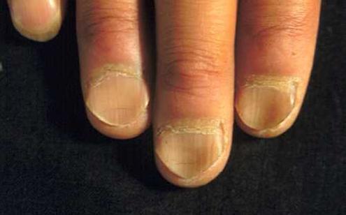 - Case (21): koilonychia (spoon-shaped nails) is a characteristic sign of iron-deficiency anemia (microcytic hypochromic anemia; Hb; MCV below 80).