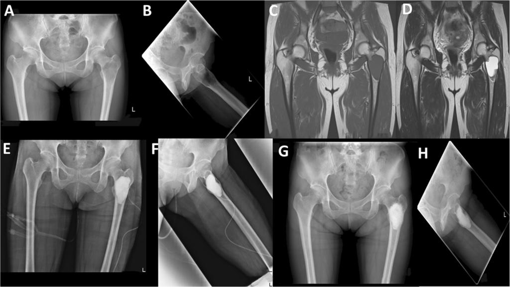 Zekry et al. Journal of Orthopaedic Surgery and Research (2018) 13:270 Page 4 of 6 Fig. 1 Case presentation representing a 37-year-old female with fibrous dysplasia of the left proximal femur.