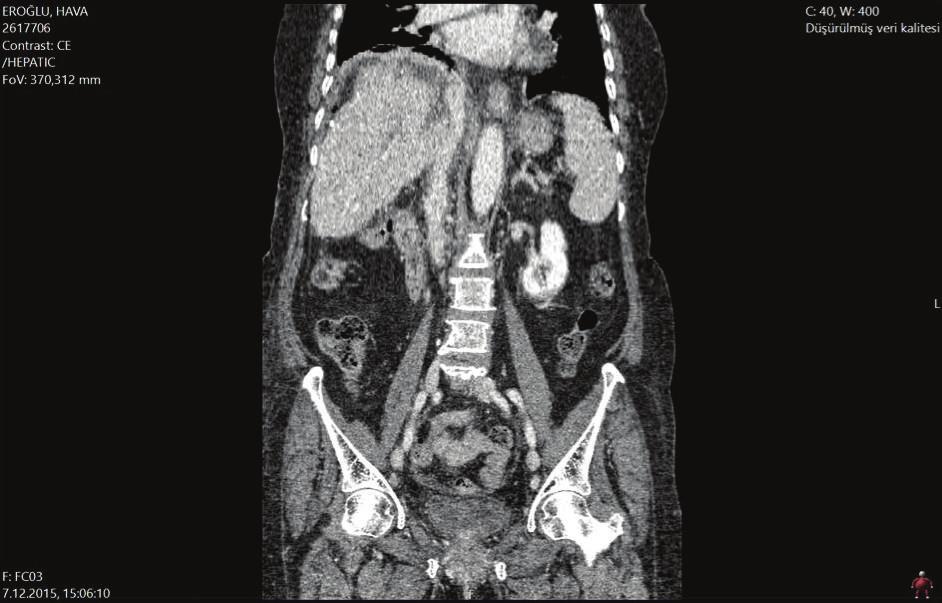 476 485, 2015. Figure 3: The postoperative sagittal section of the abdominal CT. IVC is seen as patent. complex procedure, the follow-up period of our case was very short for the oncological result.